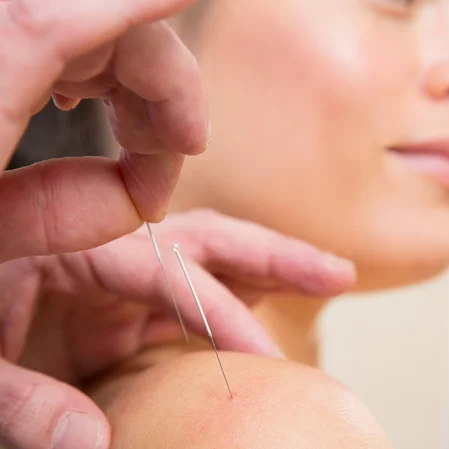 Chiropractic Lexington KY Dry Needling